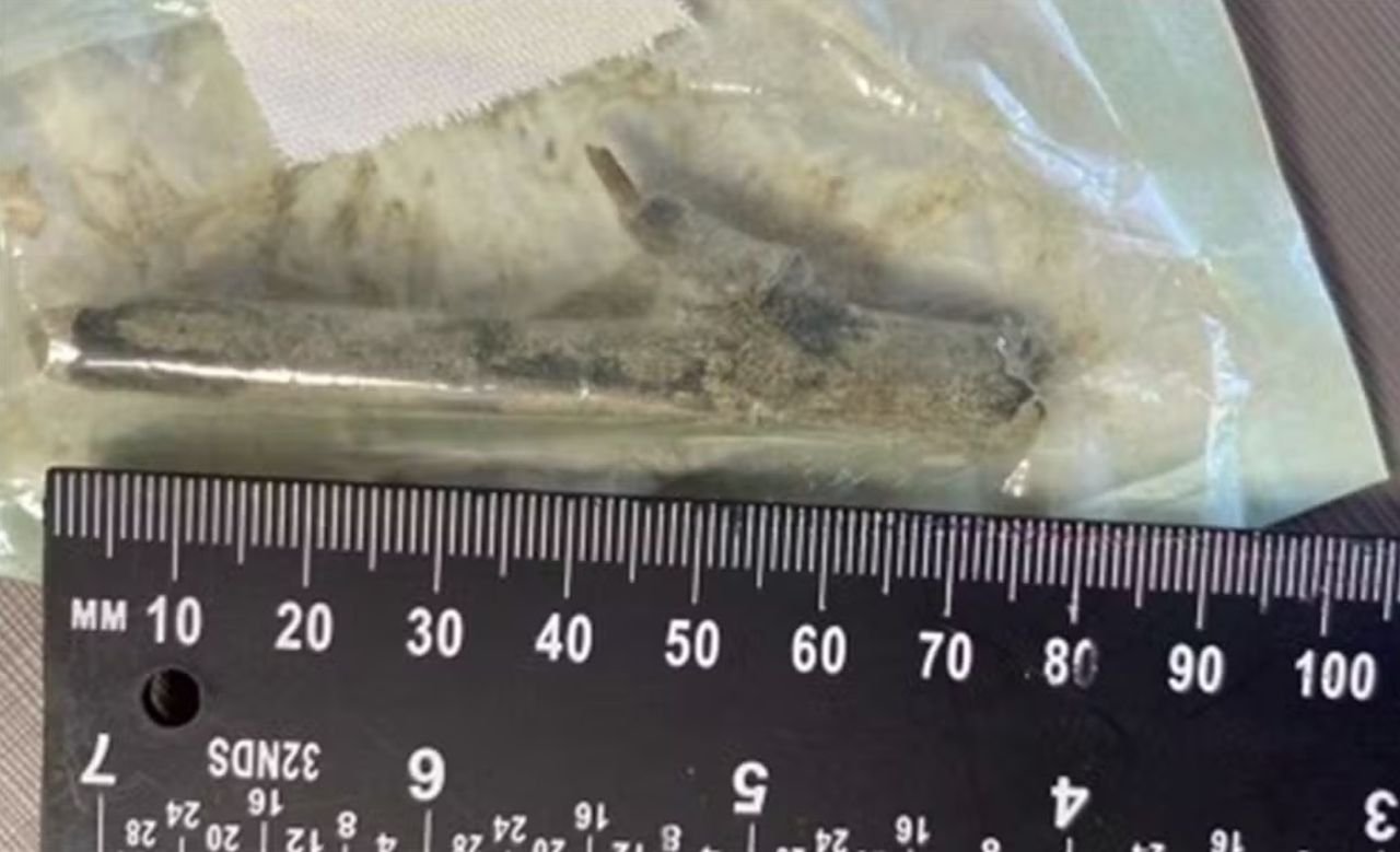 Paciente será indenizado após sair de hospital em SC com pedaço de madeira de 8 cm na perna